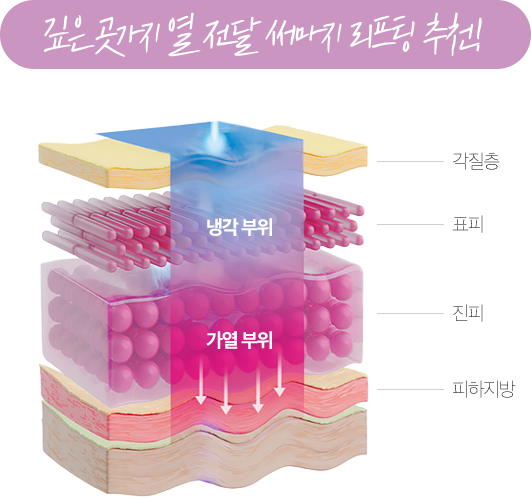 깊은 곳까지 열 전달 써마지 리프팅 추천